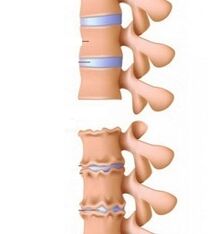 A nyak osteokondrózisának rámpáinak szakaszai