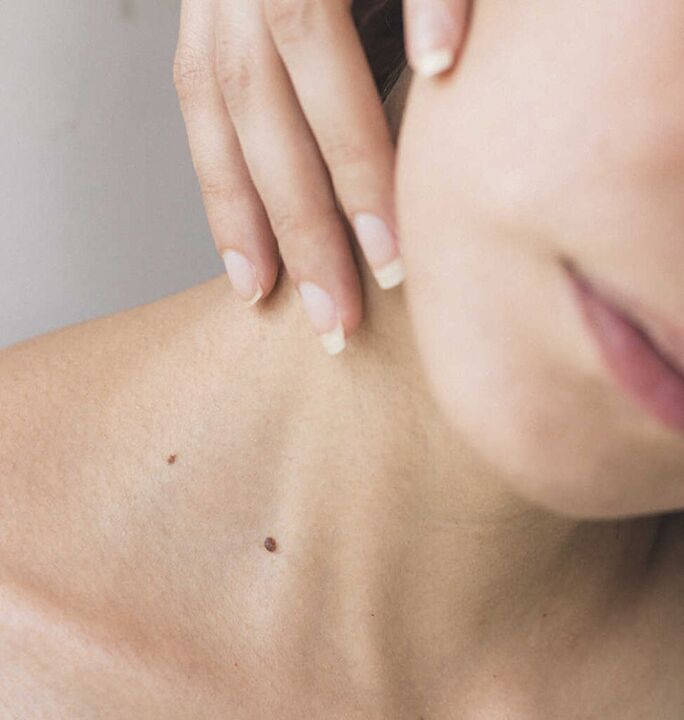 A nyaki merevség a nyaki gerinc osteochondrosisának kezdeti szakaszának egyik tünete