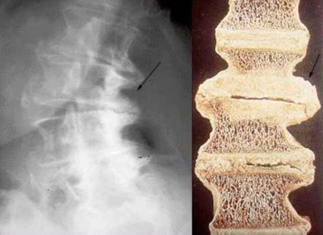 a csigolyák károsodása mellkasi osteochondrosisban
